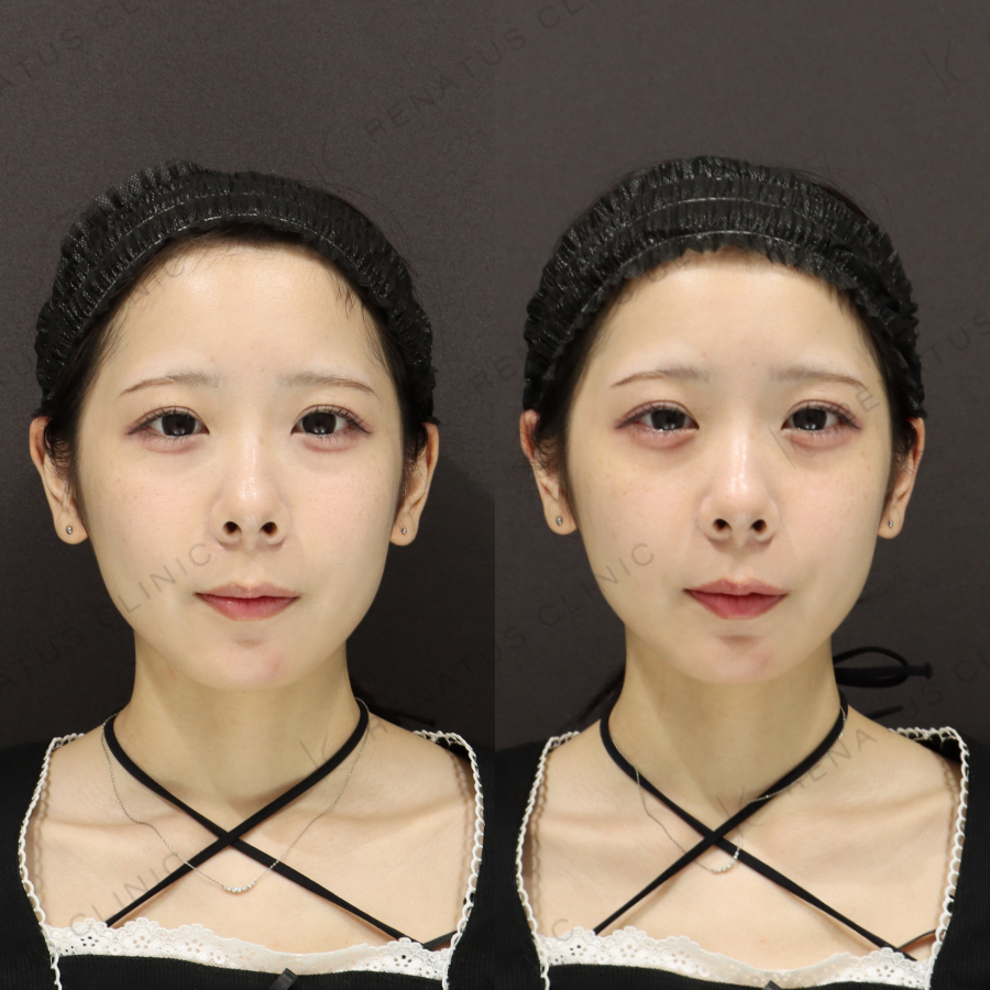 涙袋ヒアルロン酸症例写真