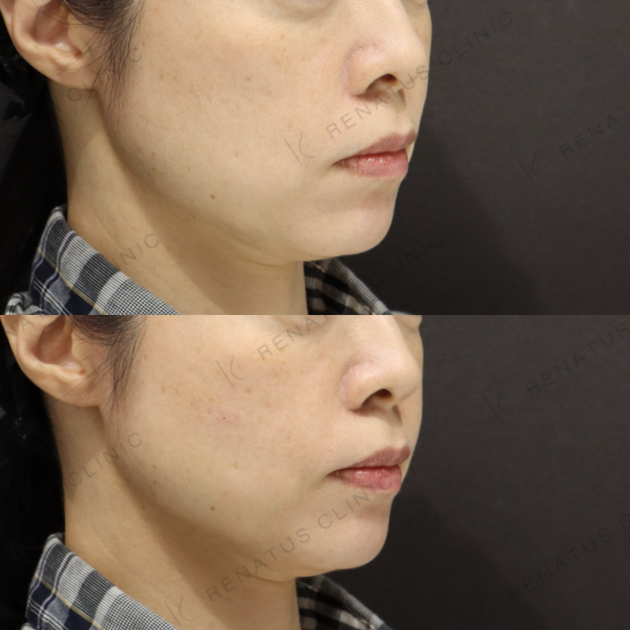 頬ヒアルロン酸症例写真