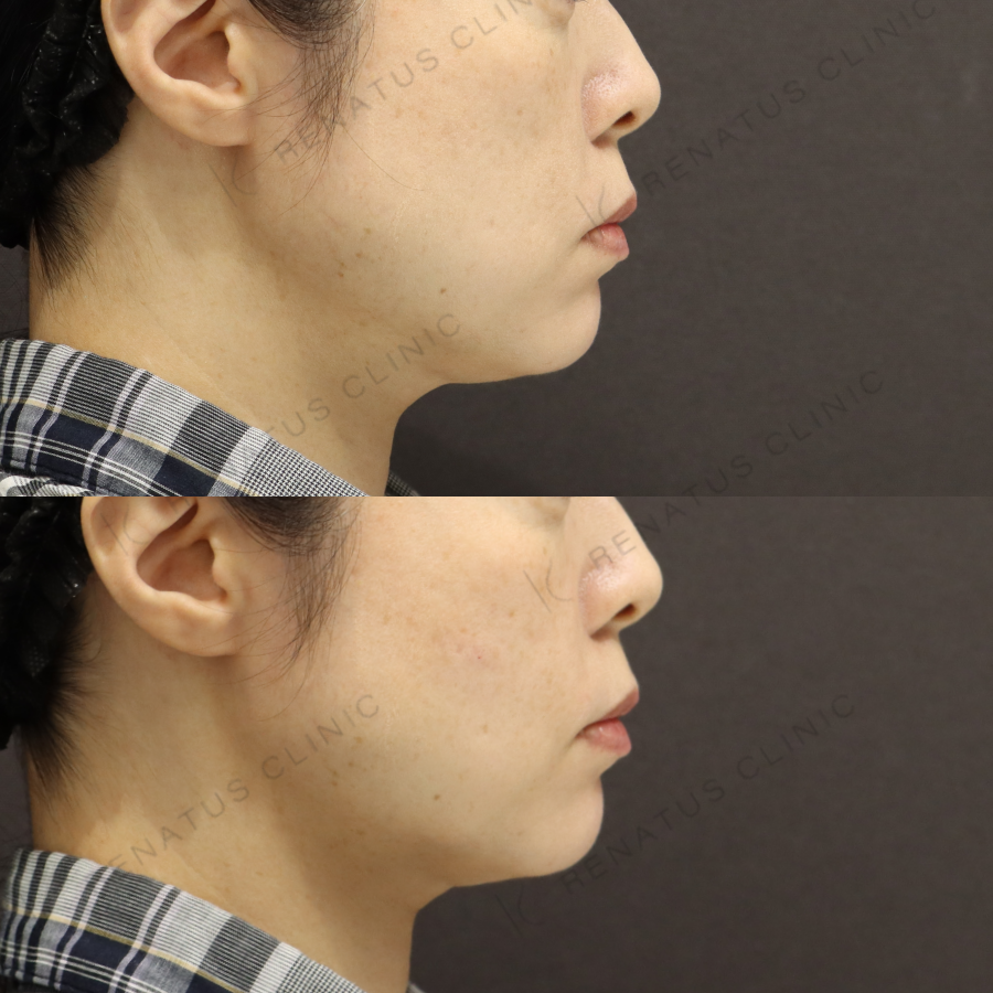 頬ヒアルロン酸症例写真