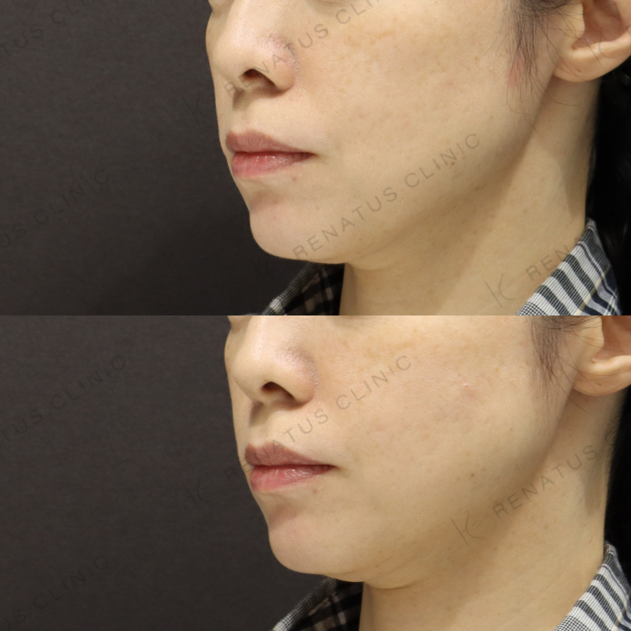 頬ヒアルロン酸症例写真