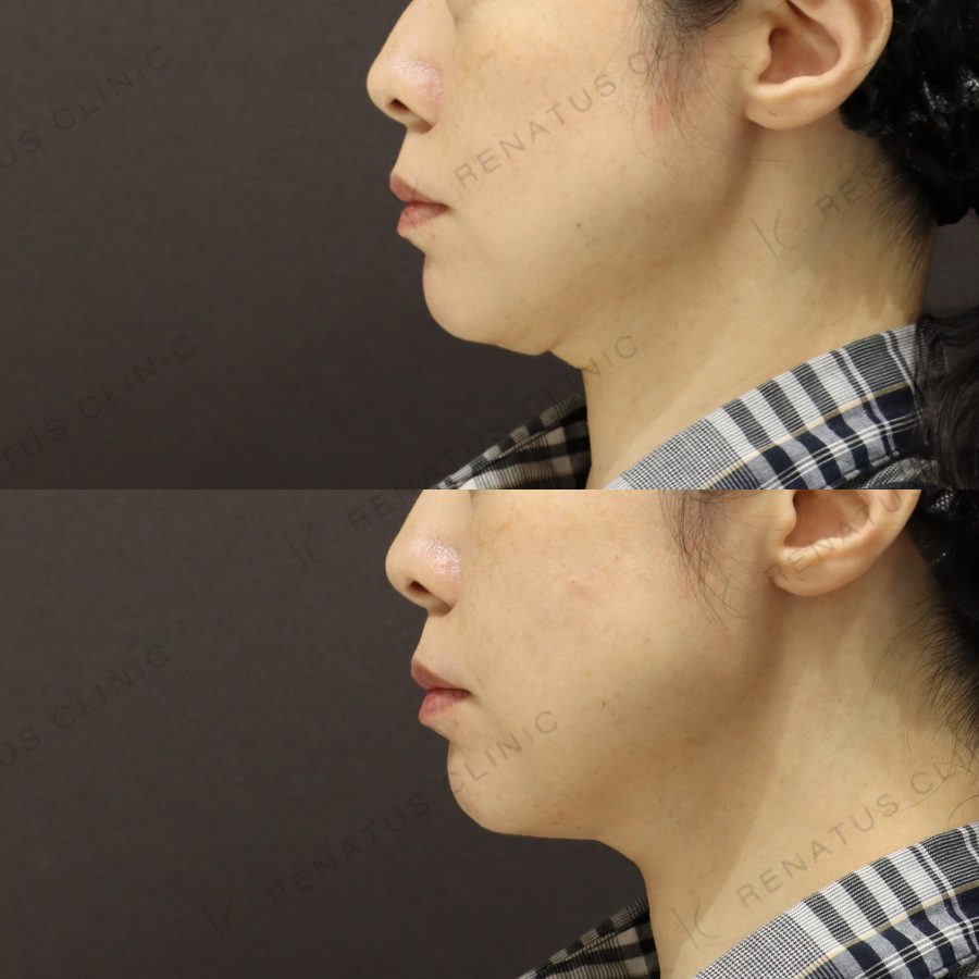 頬ヒアルロン酸症例写真