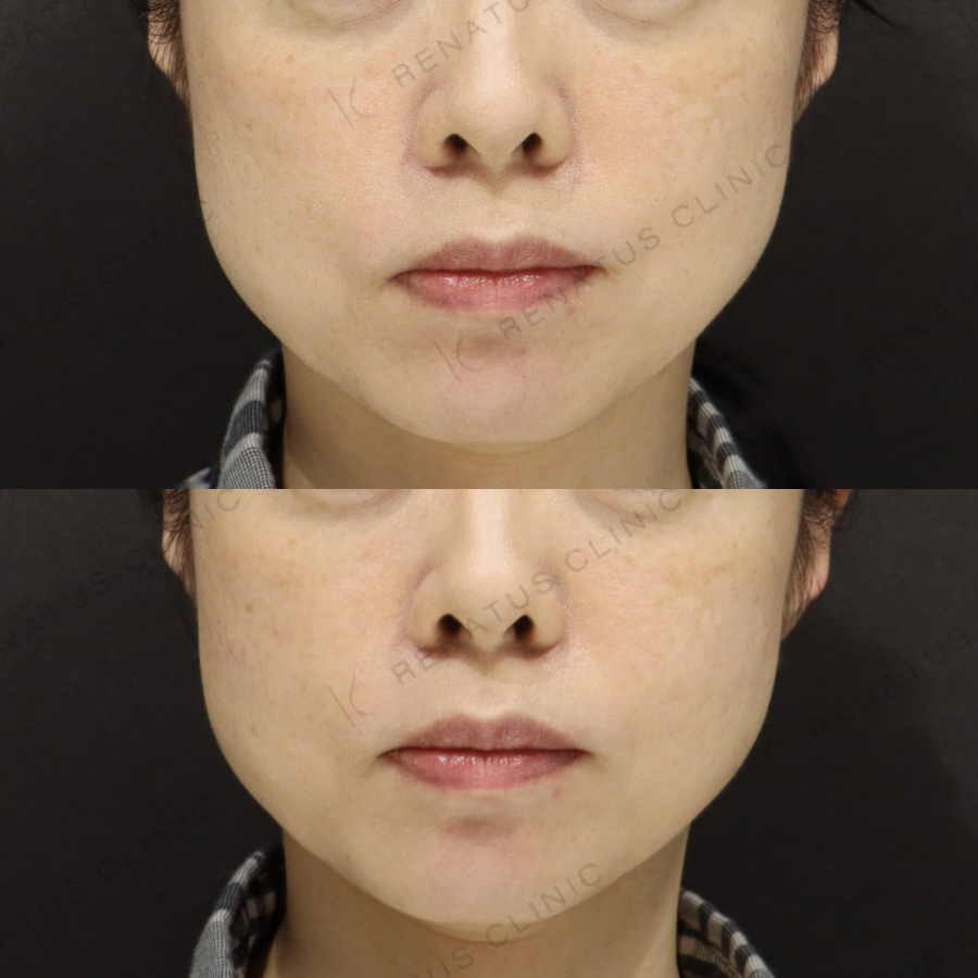 頬ヒアルロン酸症例写真