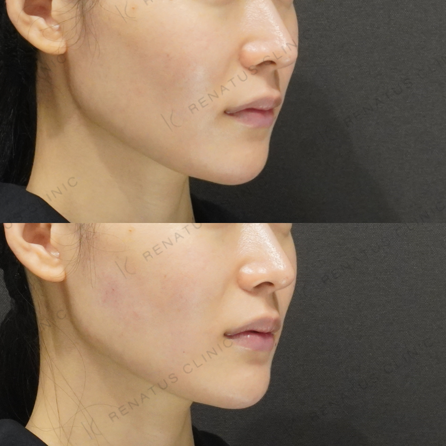 顎・頬ヒアルロン酸症例写真