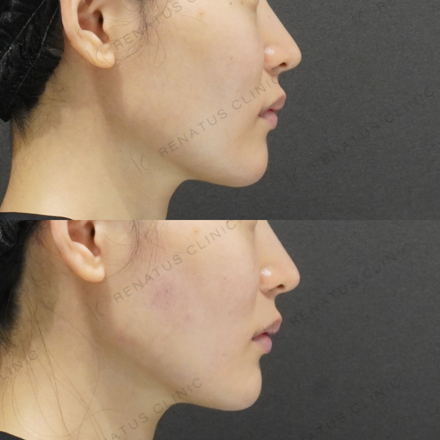 顎・頬ヒアルロン酸症例写真