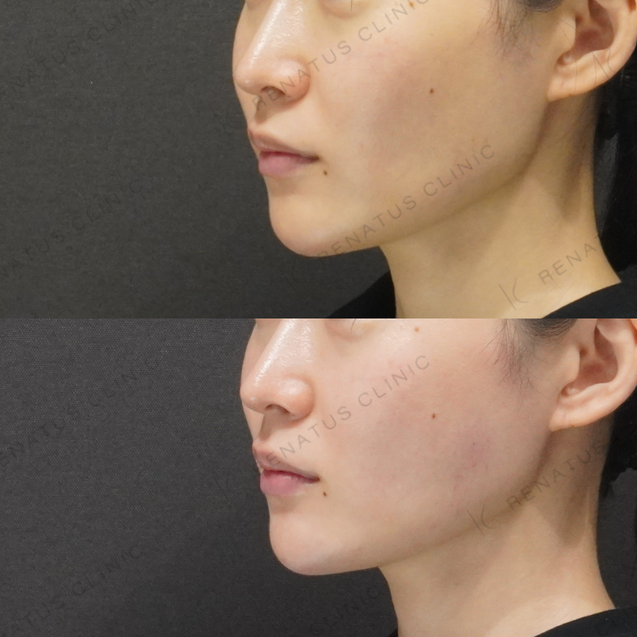 顎・頬ヒアルロン酸症例写真