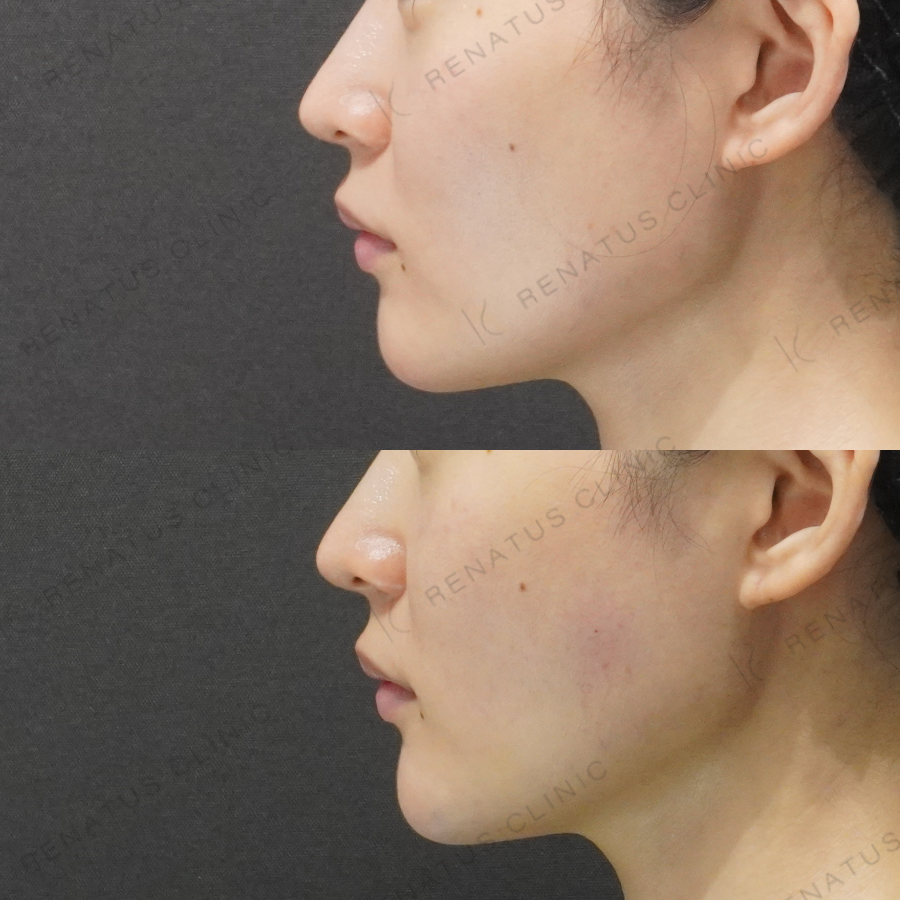 顎・頬ヒアルロン酸症例写真