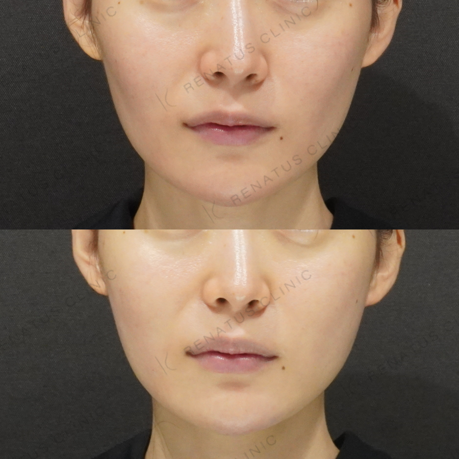 顎・頬ヒアルロン酸症例写真