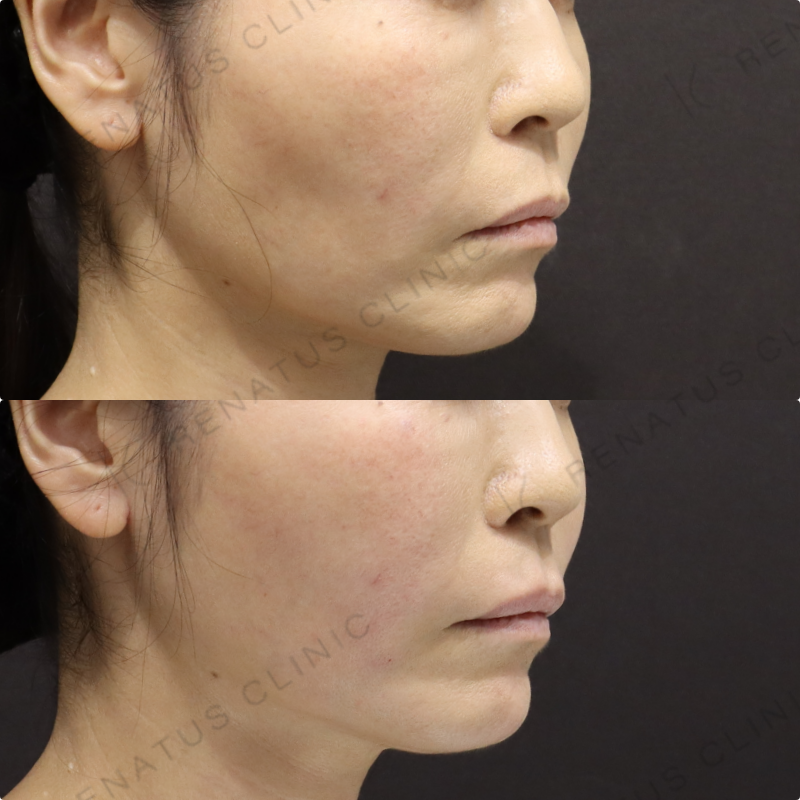 頬ヒアルロン酸症例写真