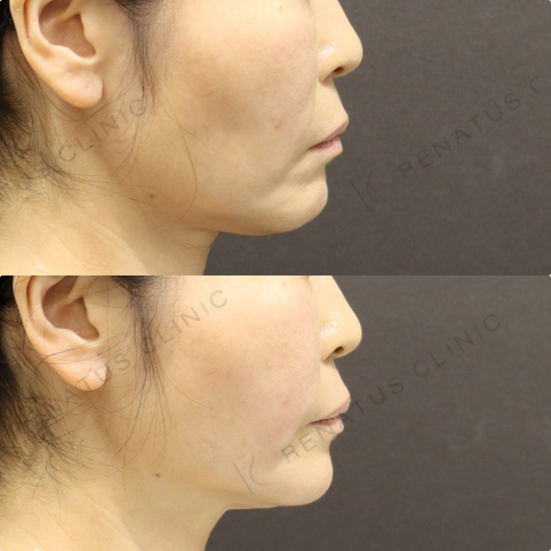 頬ヒアルロン酸症例写真