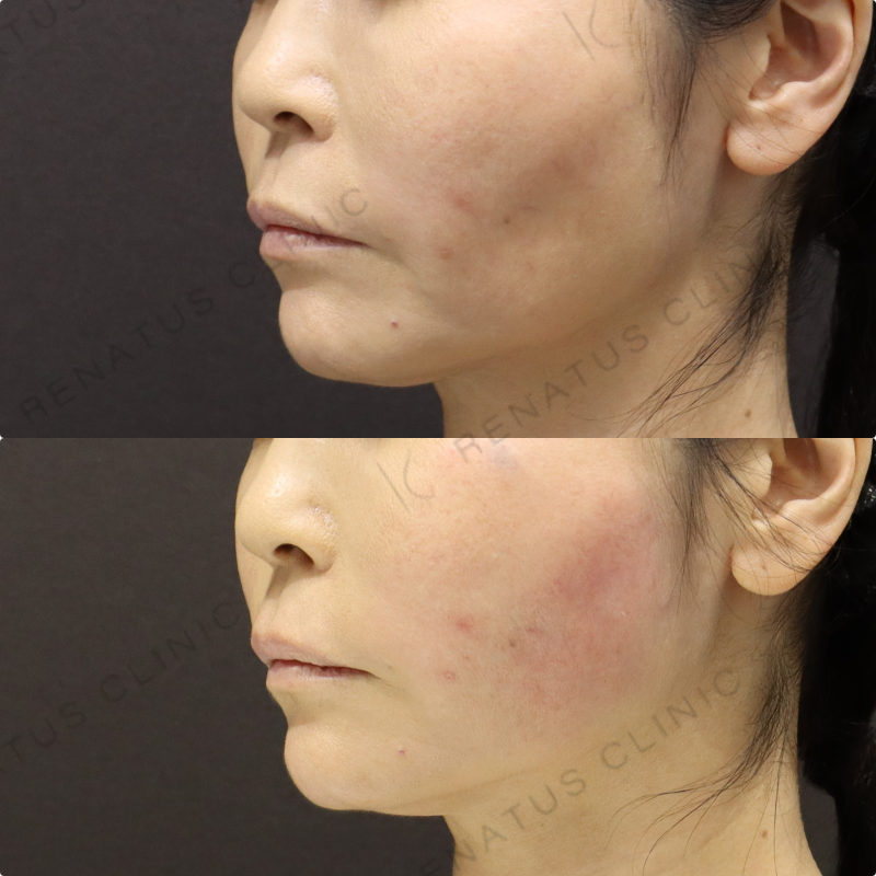 頬ヒアルロン酸症例写真