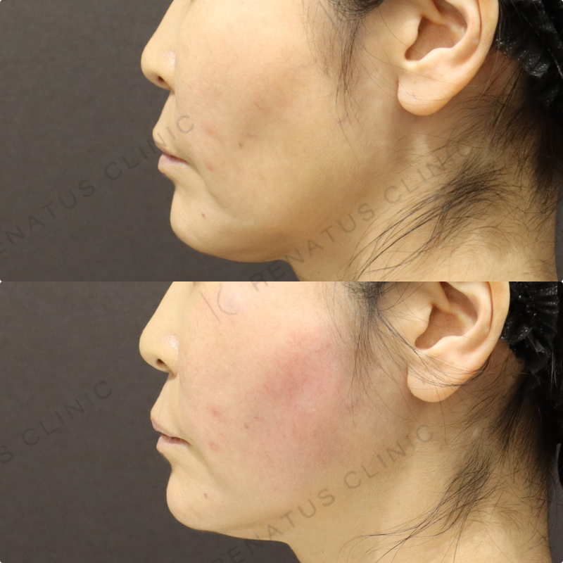 頬ヒアルロン酸症例写真