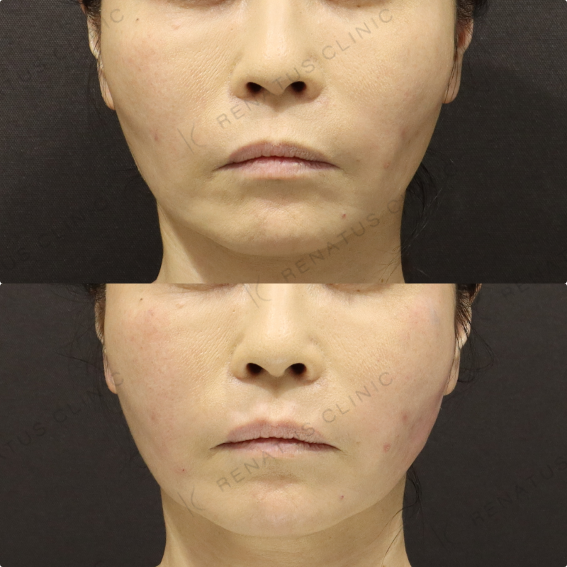 頬ヒアルロン酸症例写真