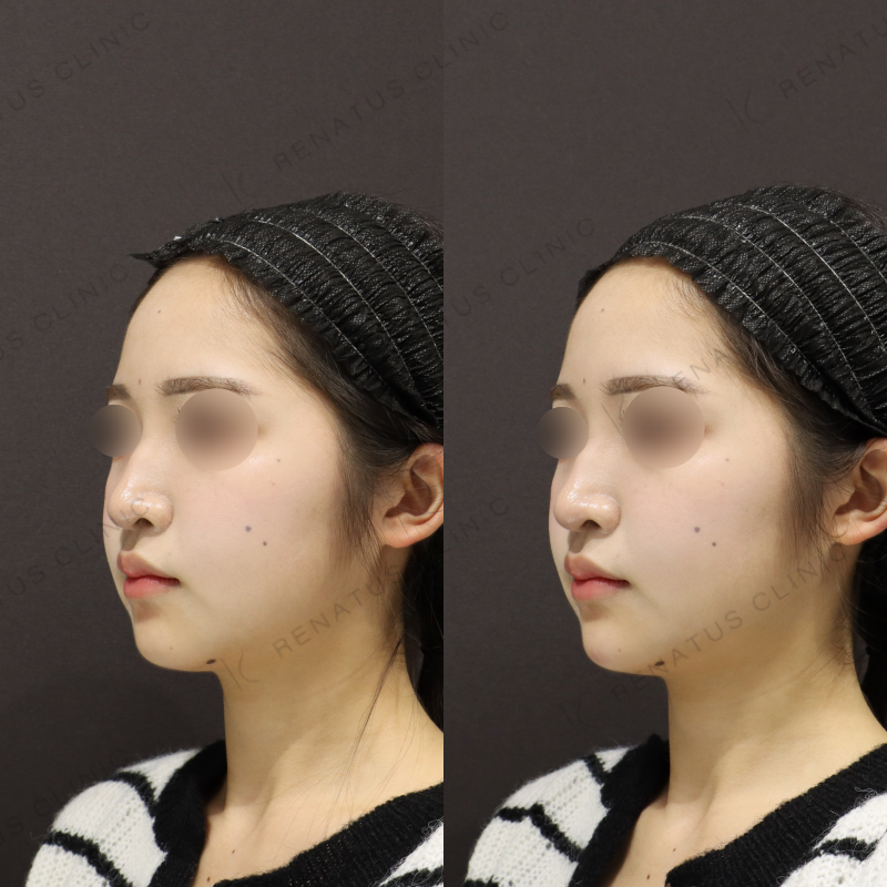 顎ヒアルロン酸症例写真