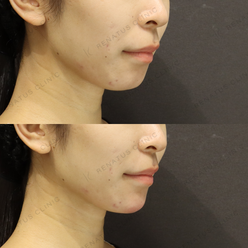 顎ヒアルロン酸症例写真