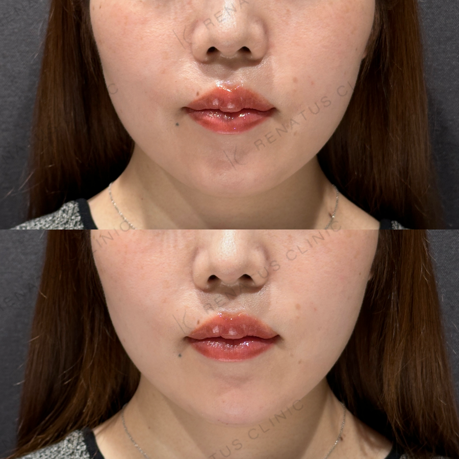 顎ヒアルロン酸症例写真