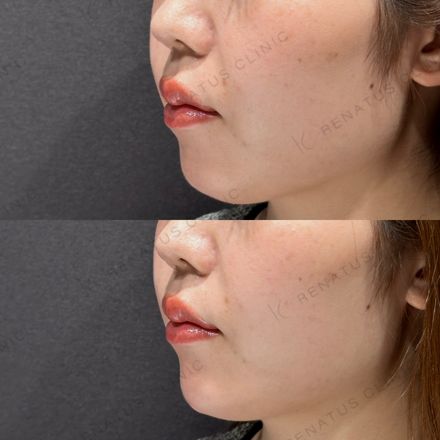 顎ヒアルロン酸症例写真