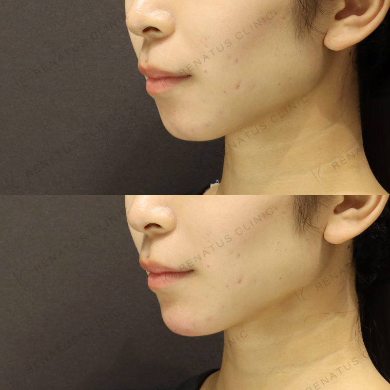 顎ヒアルロン酸症例写真