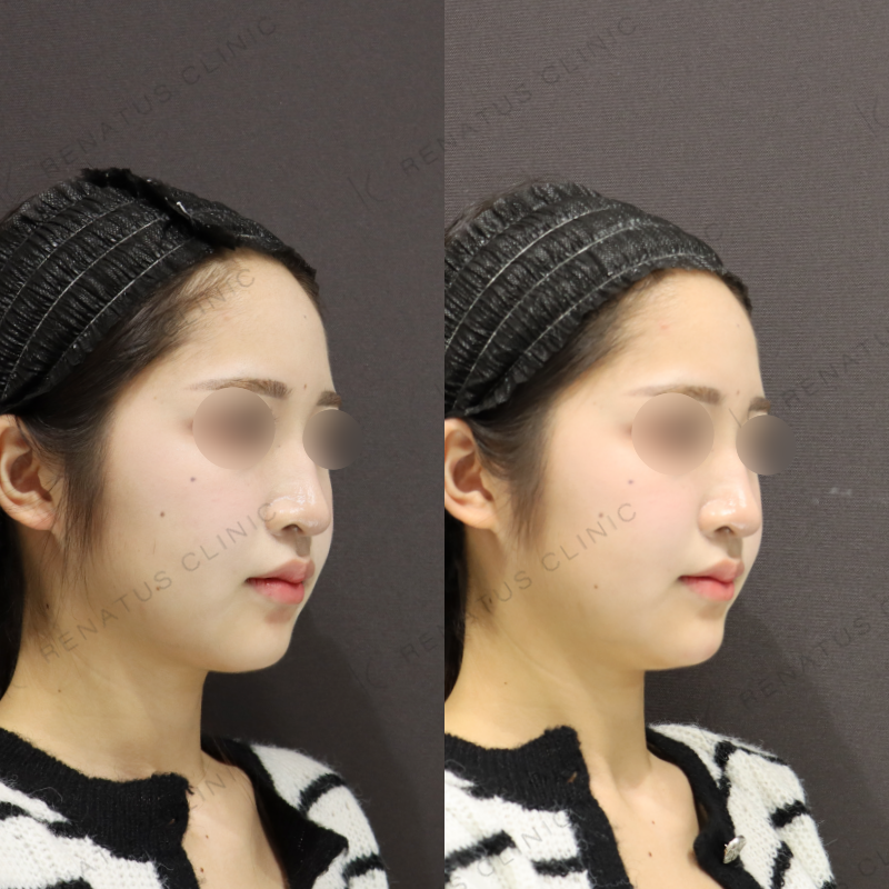 顎ヒアルロン酸症例写真