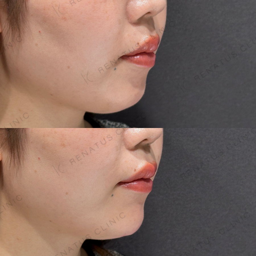 顎ヒアルロン酸症例写真