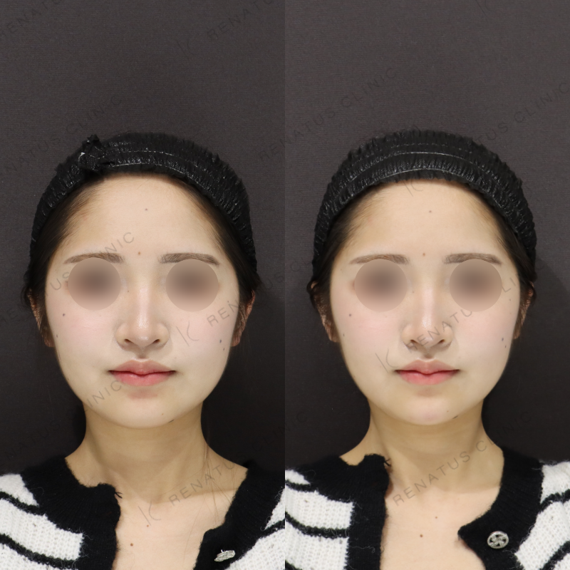 顎ヒアルロン酸症例写真