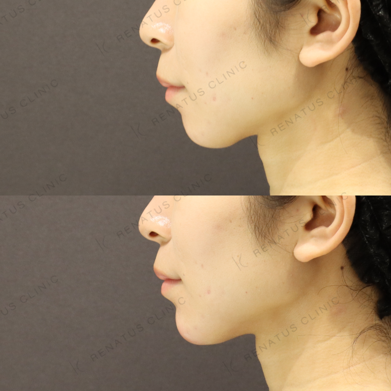 顎ヒアルロン酸症例写真