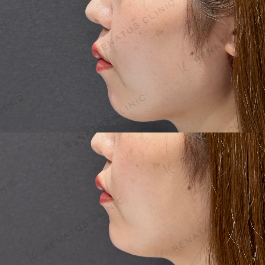 顎ヒアルロン酸症例写真
