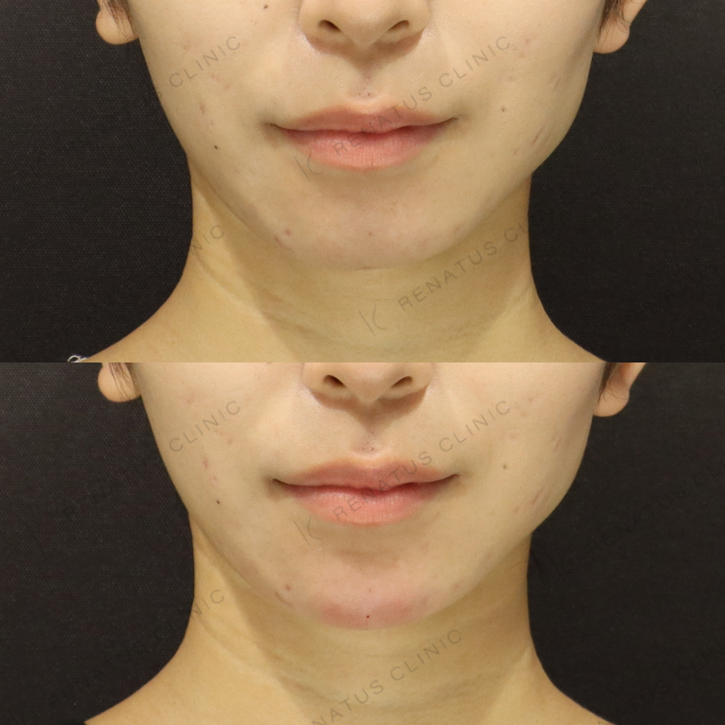 顎ヒアルロン酸症例写真