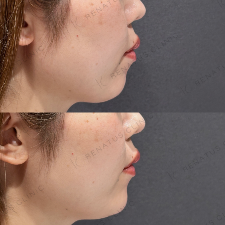 顎ヒアルロン酸症例写真