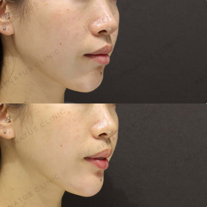 顎ヒアルロン酸症例写真