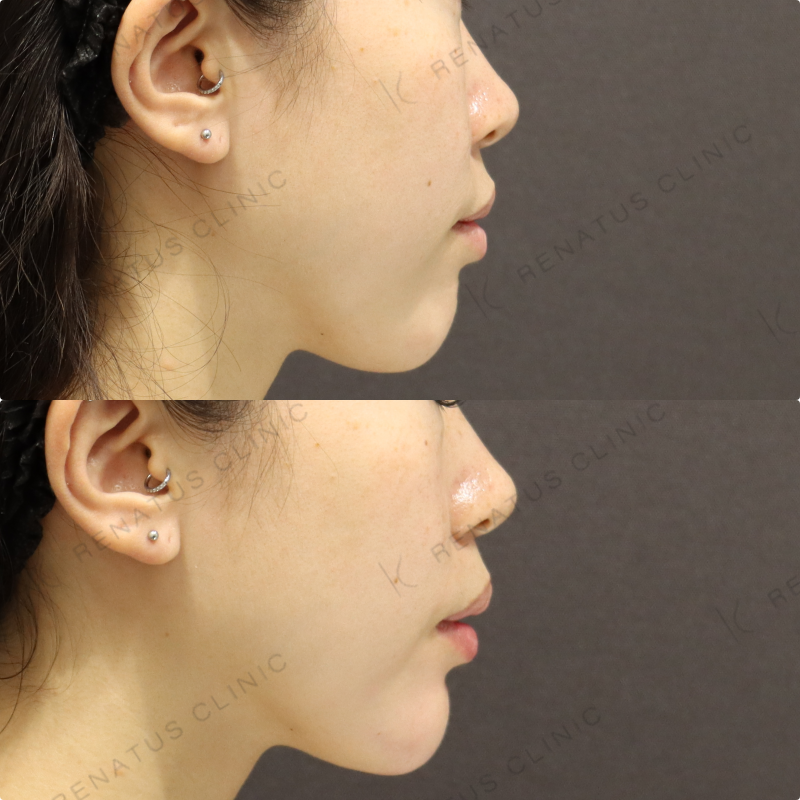 顎ヒアルロン酸症例写真