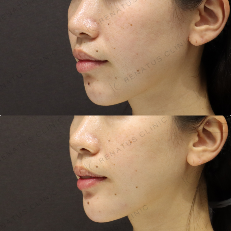 顎ヒアルロン酸症例写真