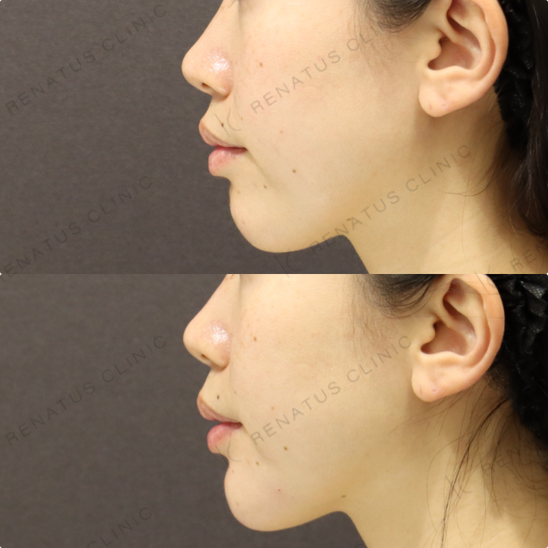 顎ヒアルロン酸症例写真