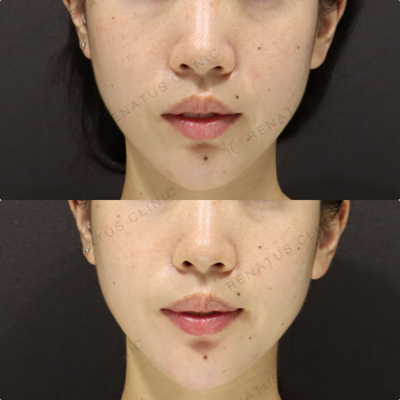 顎ヒアルロン酸症例写真