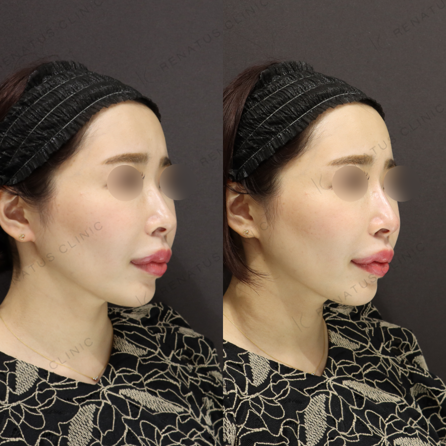 鼻ヒアルロン酸症例写真