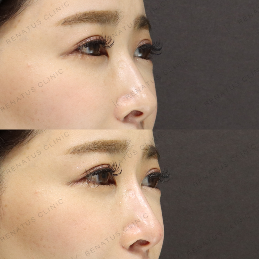 鼻ヒアルロン酸症例写真