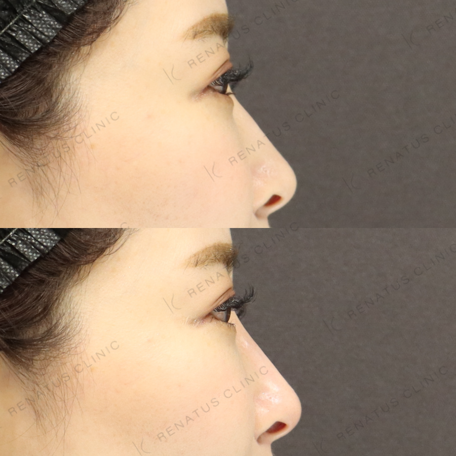 鼻ヒアルロン酸症例写真