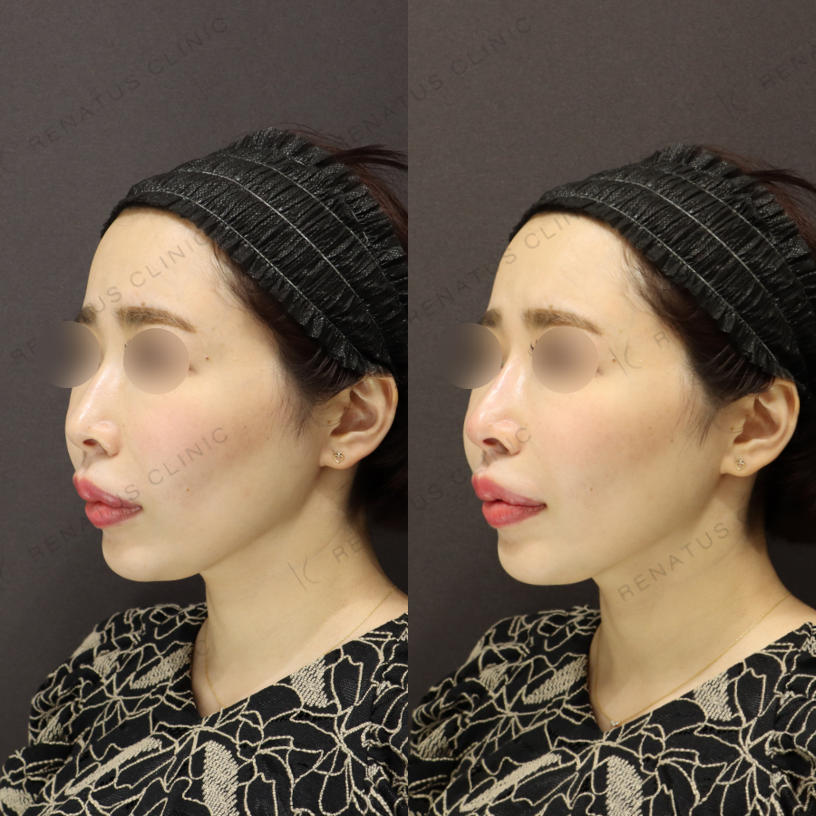 鼻ヒアルロン酸症例写真