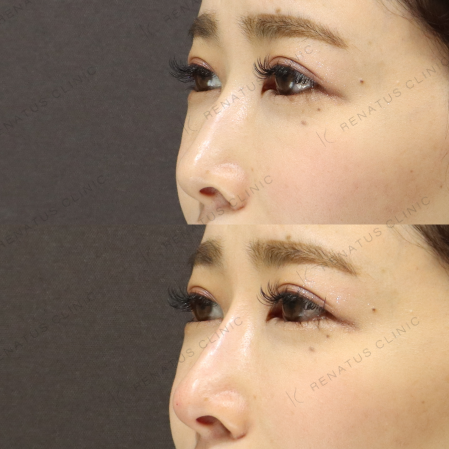 鼻ヒアルロン酸症例写真