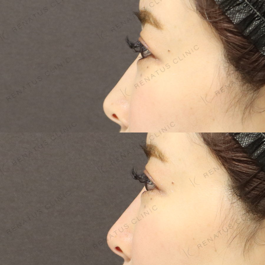 鼻ヒアルロン酸症例写真