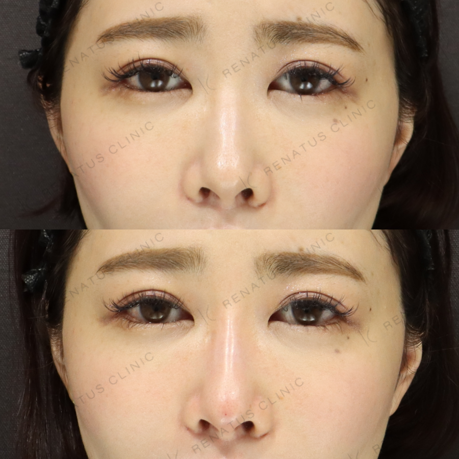 鼻ヒアルロン酸症例写真