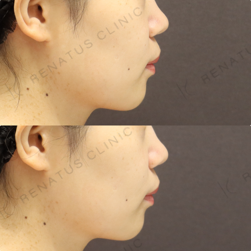 鼻翼基部ヒアルロン酸症例写真