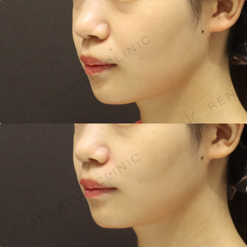 鼻翼基部ヒアルロン酸症例写真
