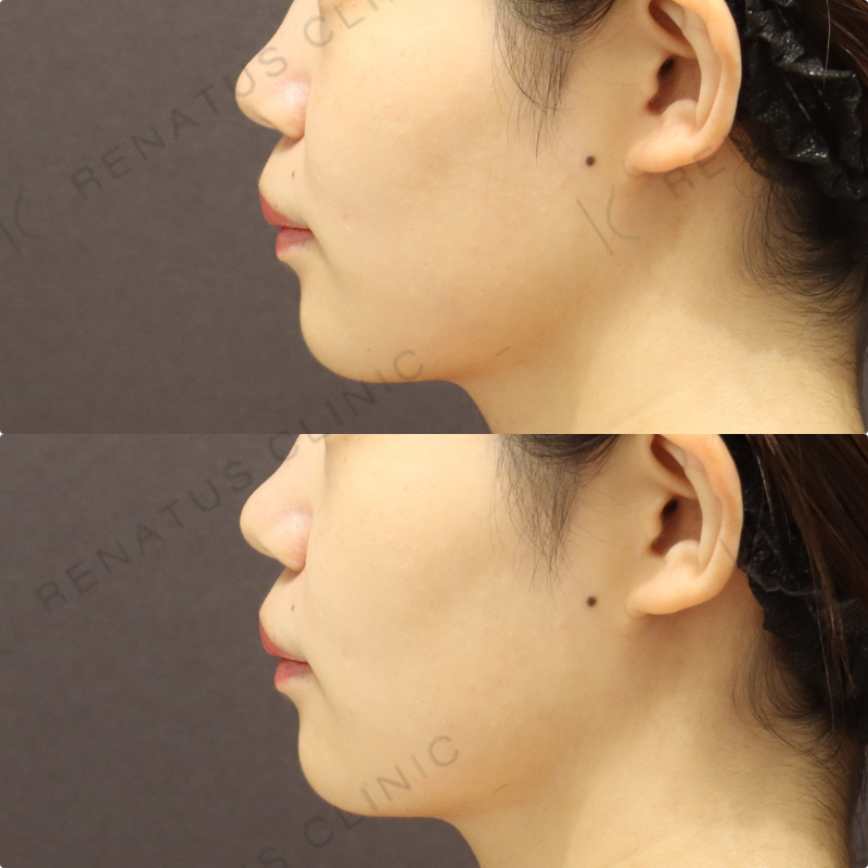 鼻翼基部ヒアルロン酸症例写真