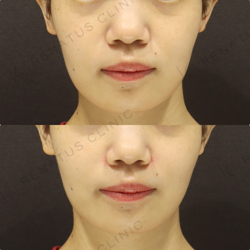 鼻翼基部ヒアルロン酸症例写真