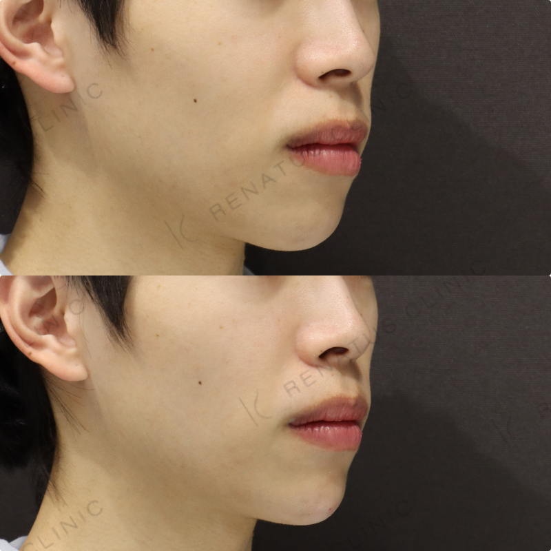 顎ヒアルロン酸症例写真