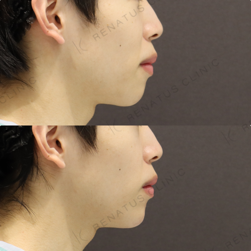 顎ヒアルロン酸症例写真