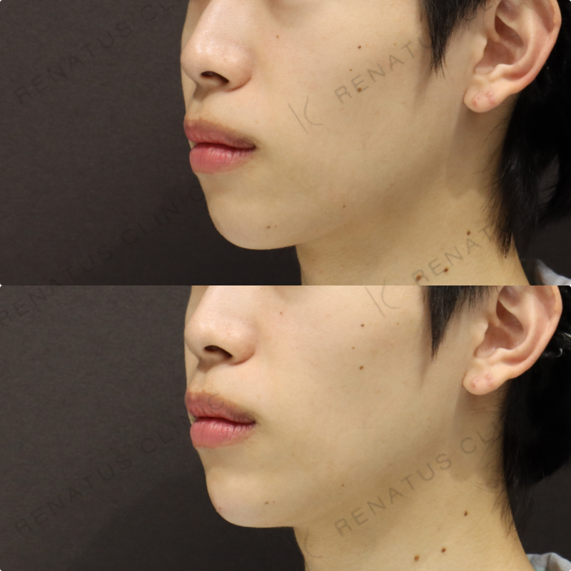 顎ヒアルロン酸症例写真