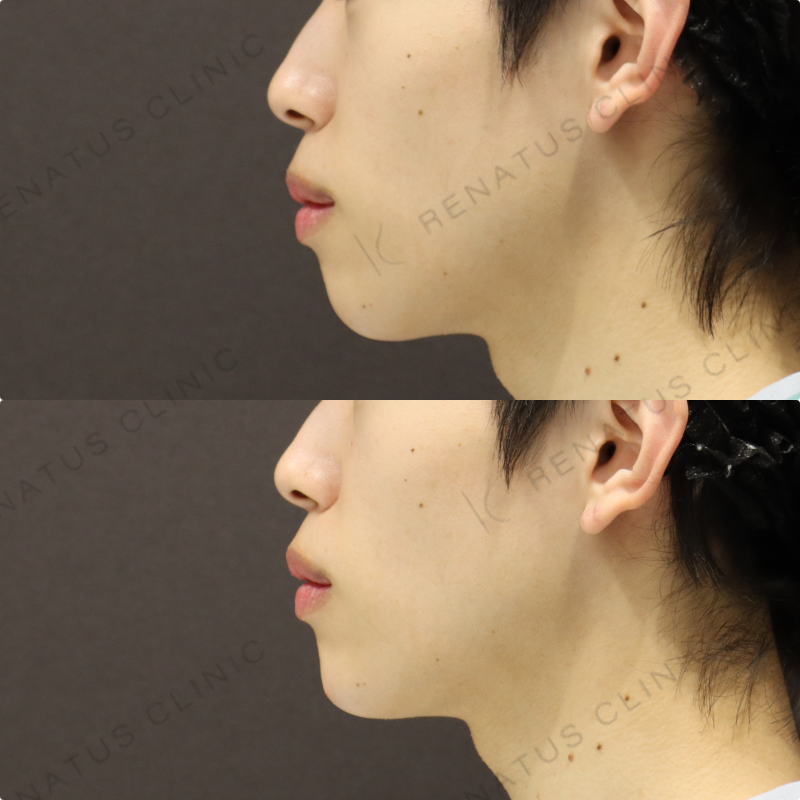 顎ヒアルロン酸症例写真