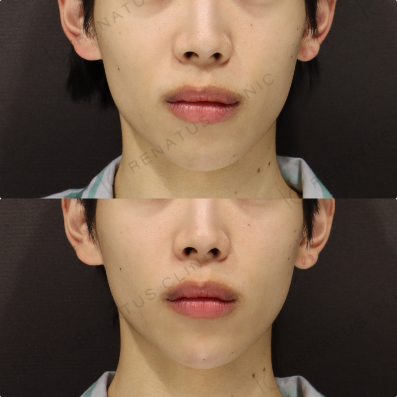 顎ヒアルロン酸症例写真