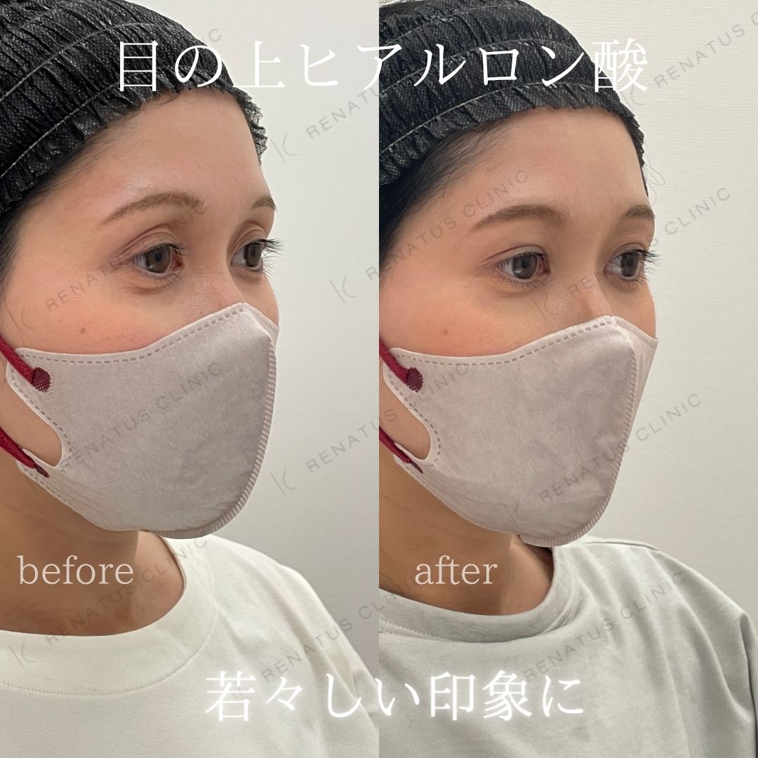 目の上ボルベラヒアルロン酸 目の上ボルベラヒアルロン酸